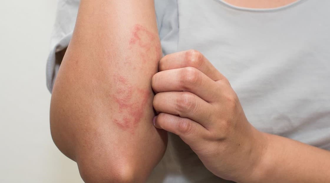 Online searches for eczema and acne decreased during Covid-19 lockdown